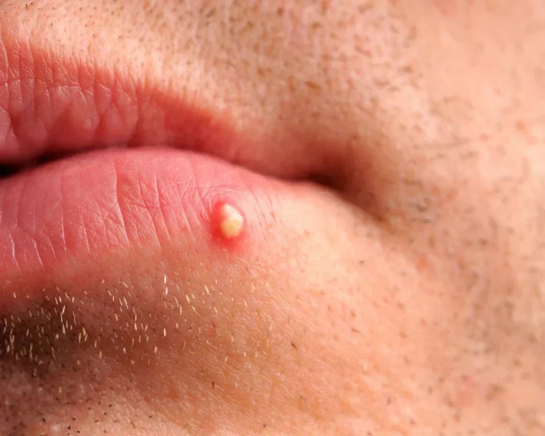 Close-up of a pustule on the lower lip showing a white pus-filled center surrounded by inflamed red skin.