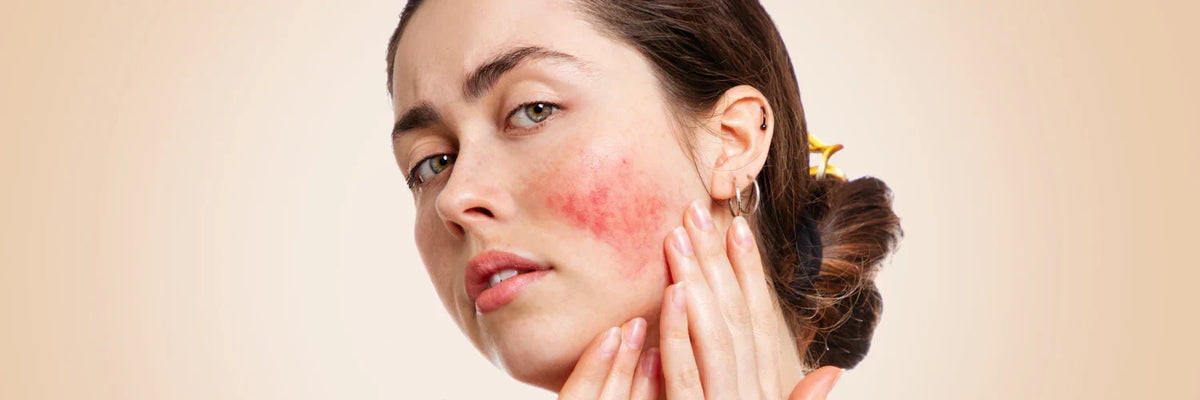 Skincare to Avoid With Redness-Prone Skin: Products and Ingredients That Worsen Appearance
