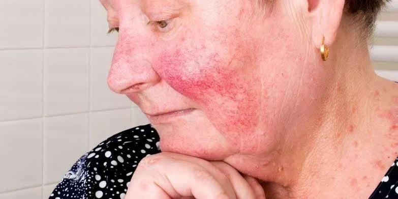 Face showing persistent facial redness and visible flushing characteristic of rosacea-prone skin appearance