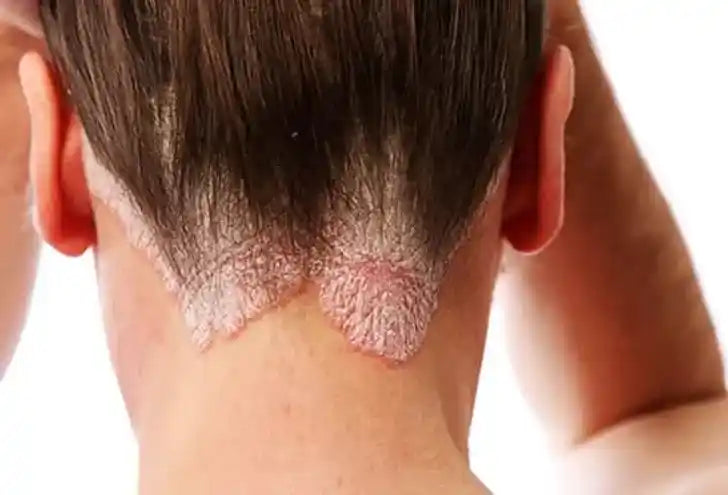 Close-up of scalp psoriasis plaques with silvery scales along the back hairline before hair dye application.