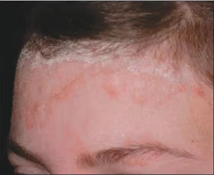 Hair Dye & Scalp Psoriasis