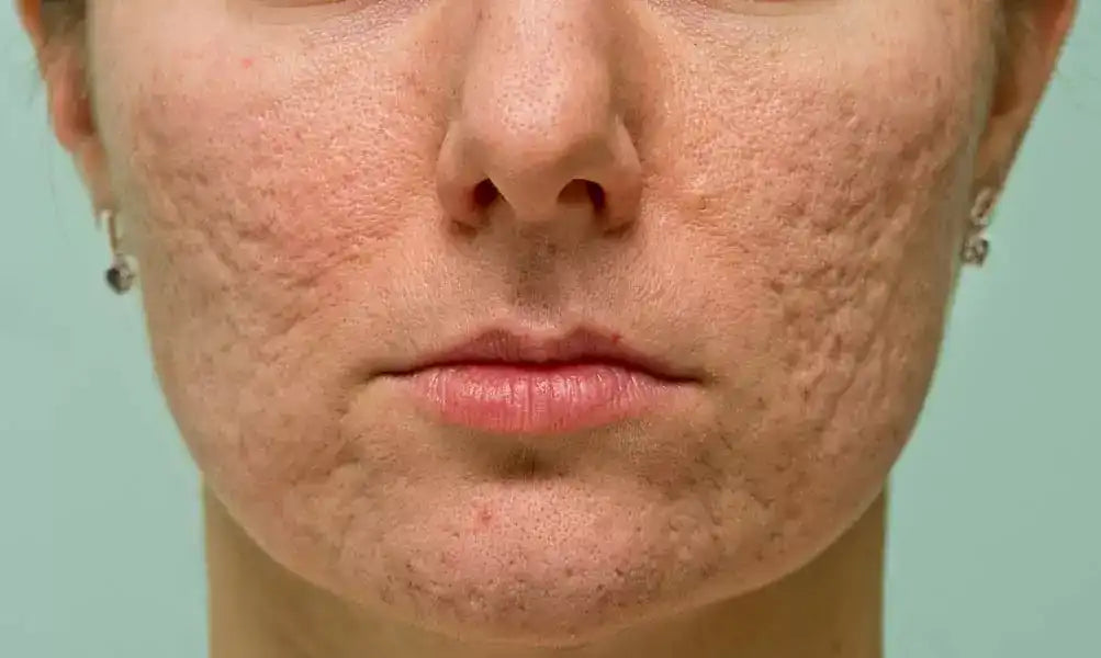 Scar formation showing inflammatory proliferative and remodeling phases of wound healing