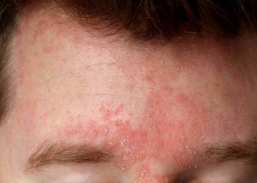  "Seborrheic dermatitis on deeper skin, showing discoloured rather than red patches"