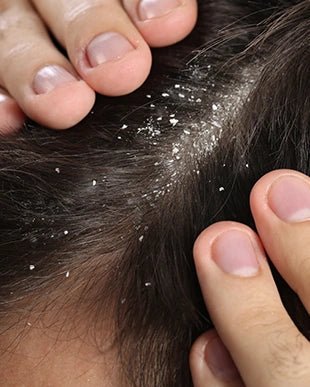 "The scalp microbiome and Malassezia — the balance behind seborrheic dermatitis"