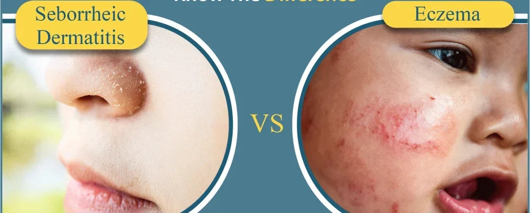  "Body-location map: eczema in skin creases vs seborrheic dermatitis in oily zones"