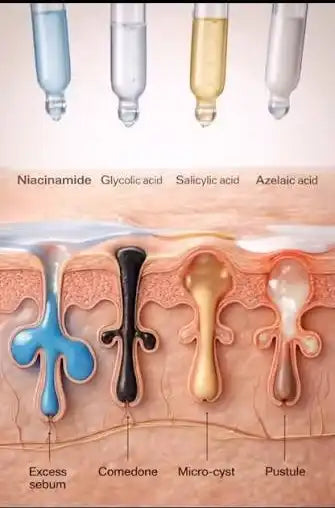 Sebaceous gland anatomy showing sebocytes and sebum production in the pilosebaceous unit