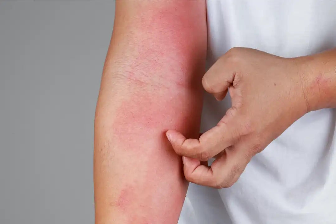 Woman with visible skin inflammation and redness on the hand