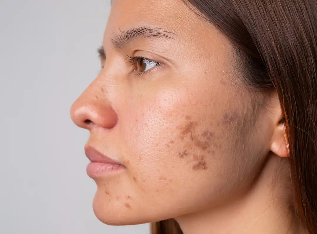 Genetic regulation of skin pigmentation showing MC1R, MITF and melanin synthesis in melanocytes