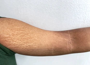 What Causes Stretch Marks?