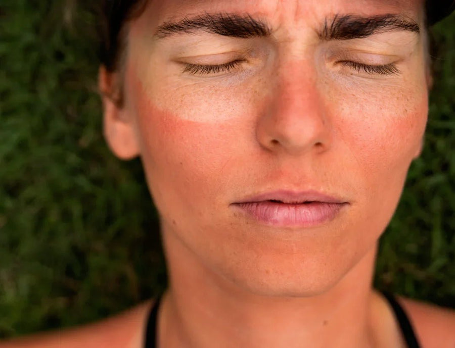 Sun Damage Explained — Signs, Ingredients & Prevention
