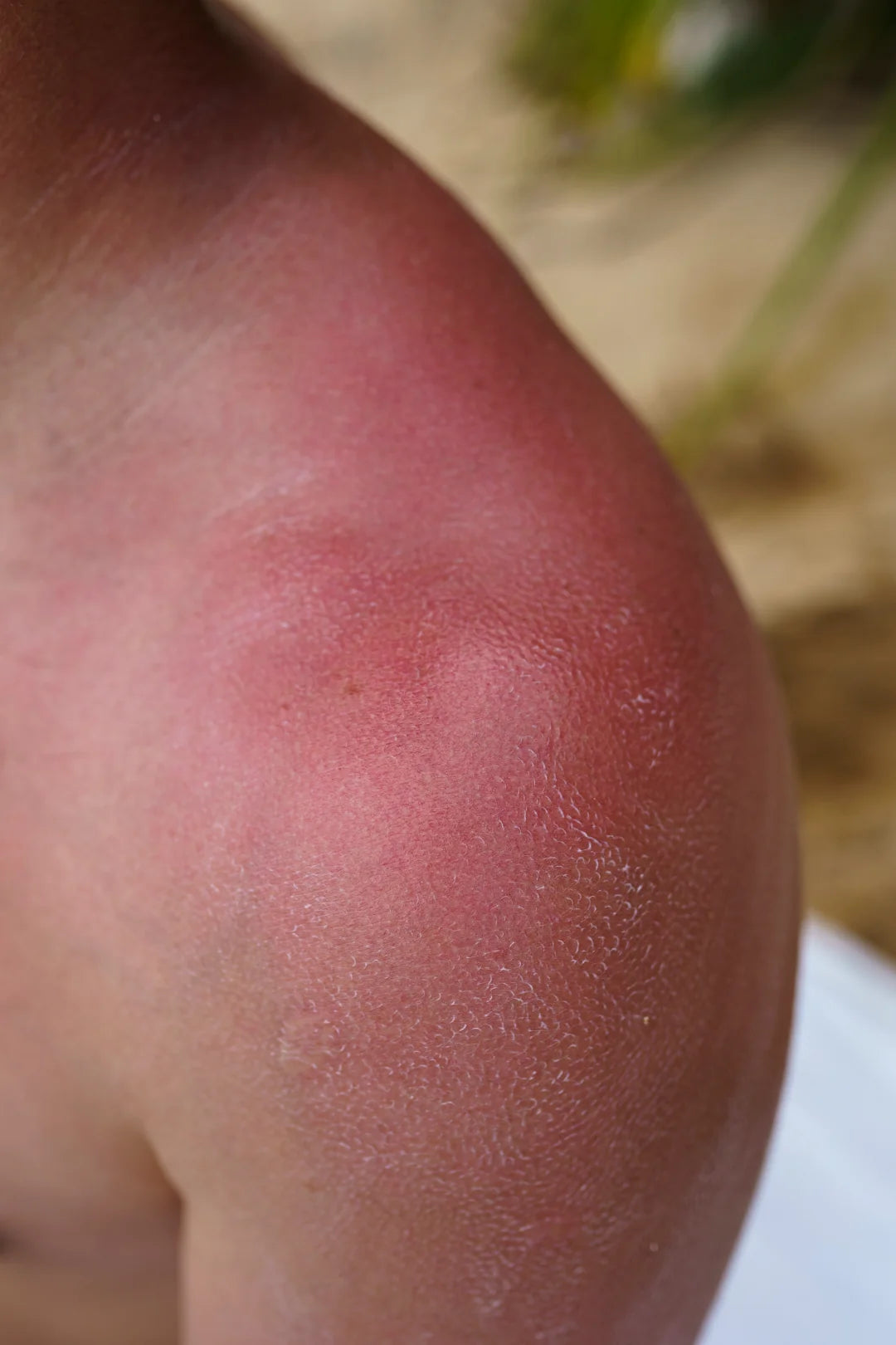 Sunburn on deeper skin tones after sun exposure