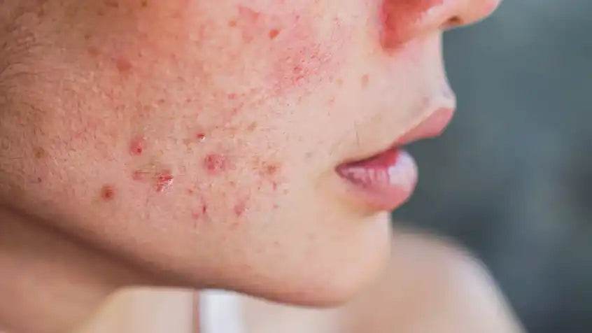 Tropical humidity effects on skin barrier function and hydration