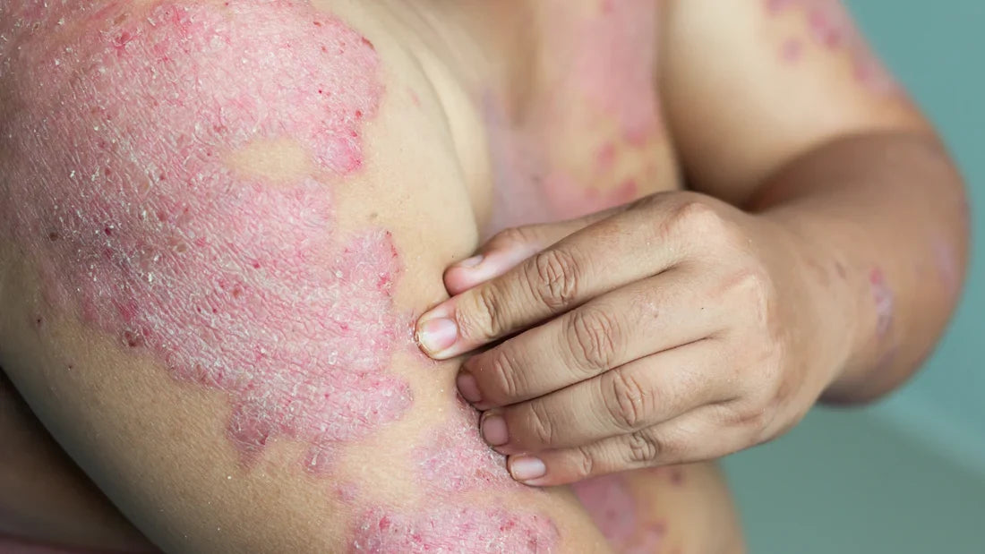 Psoriasis plaques on the upper arm with scaling, redness, and visible inflammation