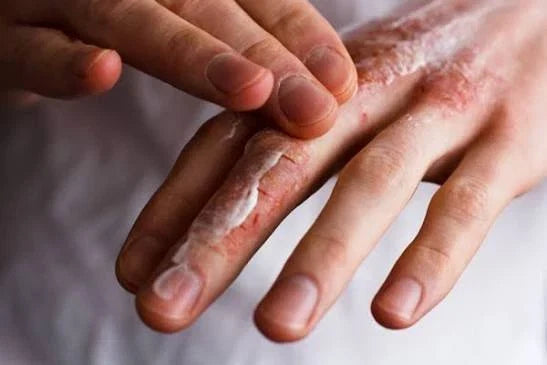 "Gentle eczema washing dos and don'ts: fragrance-free cleanser, no loofah, pat dry"