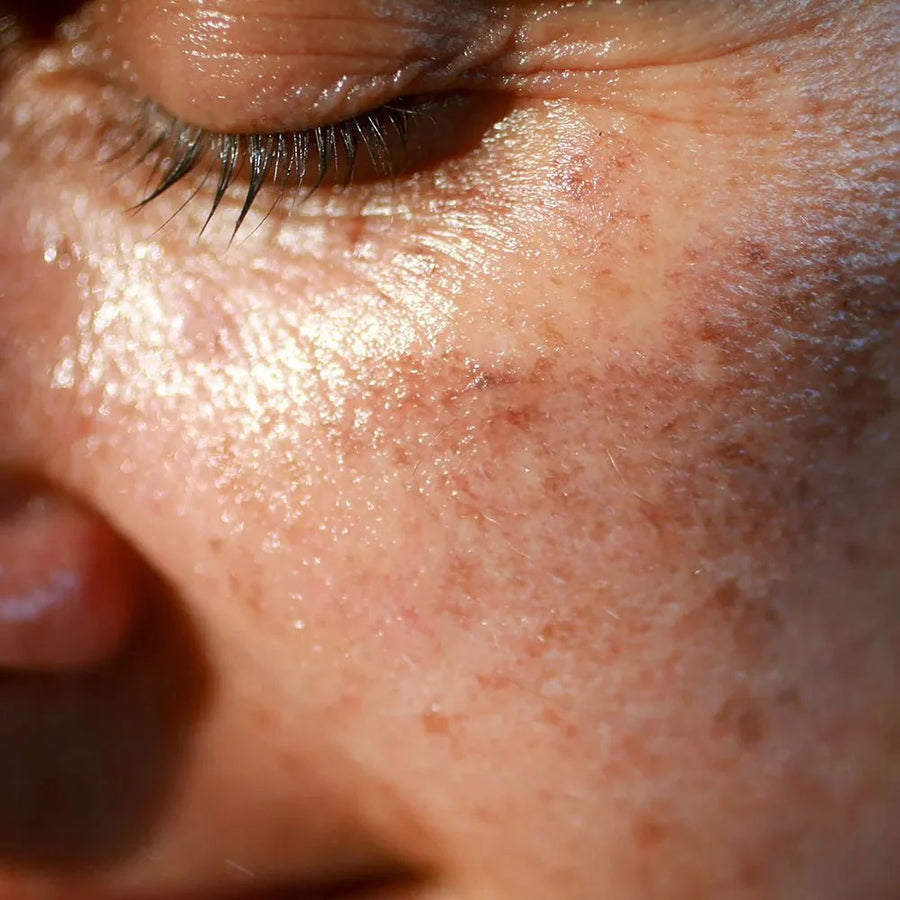 What Are Sunspots on Skin? Causes, Prevention & Simple Guide