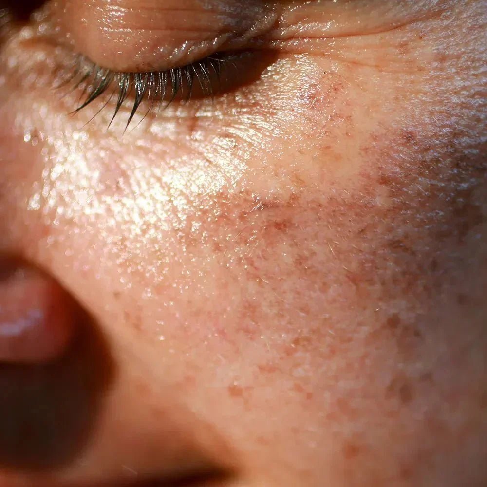 What Are Sunspots on Skin? Causes, Prevention & Simple Guide - Boldpurity Skincare