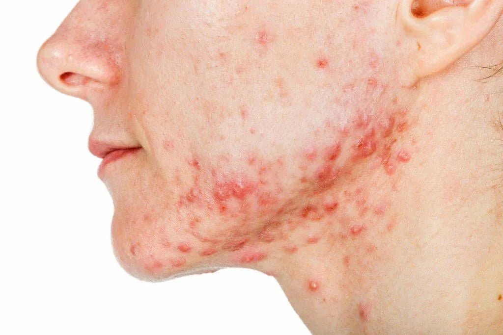 What Causes Breakouts? Common Triggers & How to Manage Them - Boldpurity Skincare