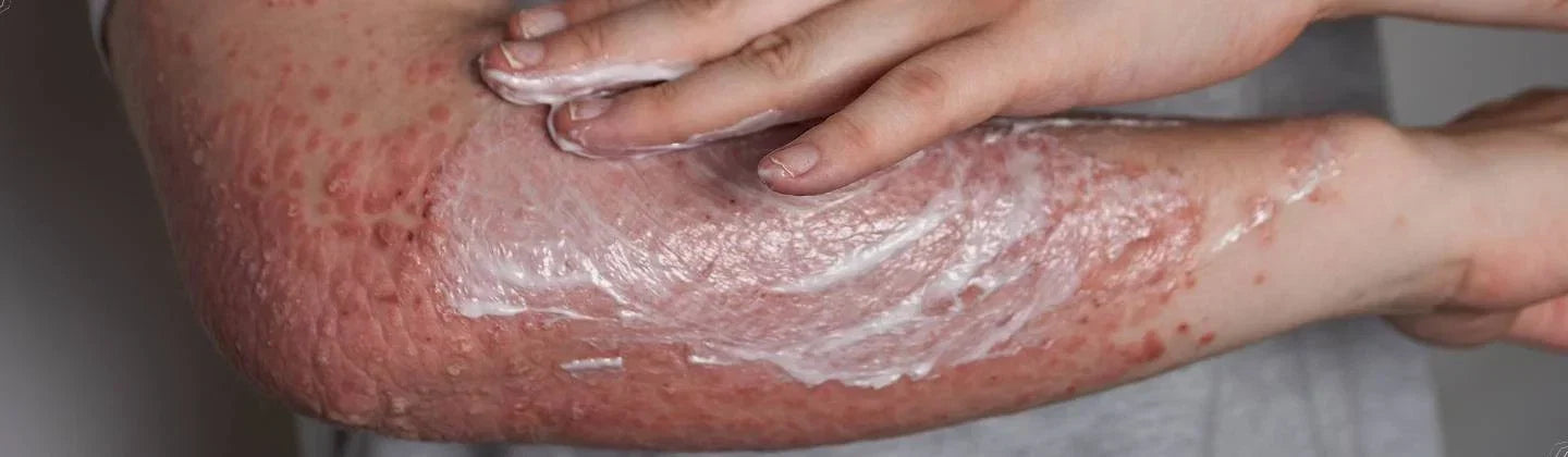 "Psoriasis plaques — a chronic immune-mediated skin condition"