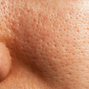 Visible Pores