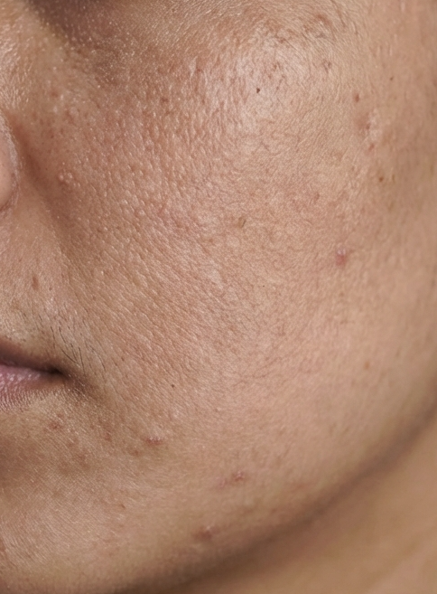 before applying cellmorph microneedling (spicule) serum