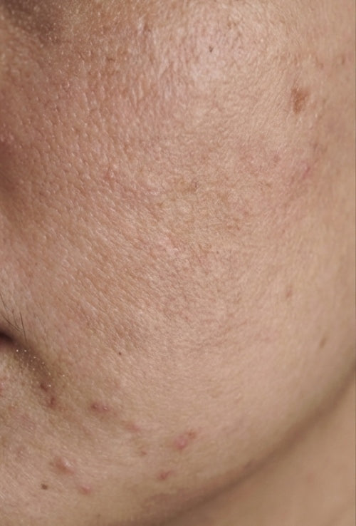 Before - Cellmorph 500 Spicule Serum